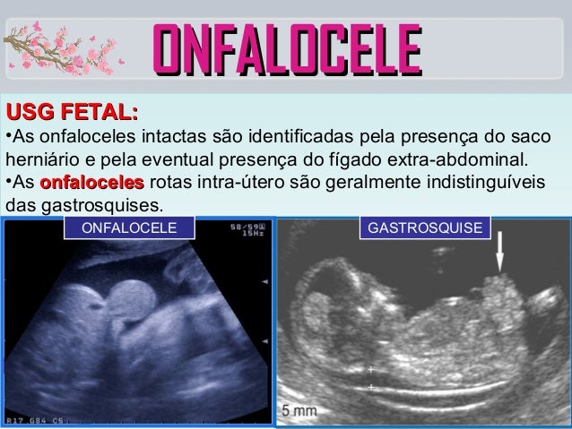 gastrosquise e onfalocele